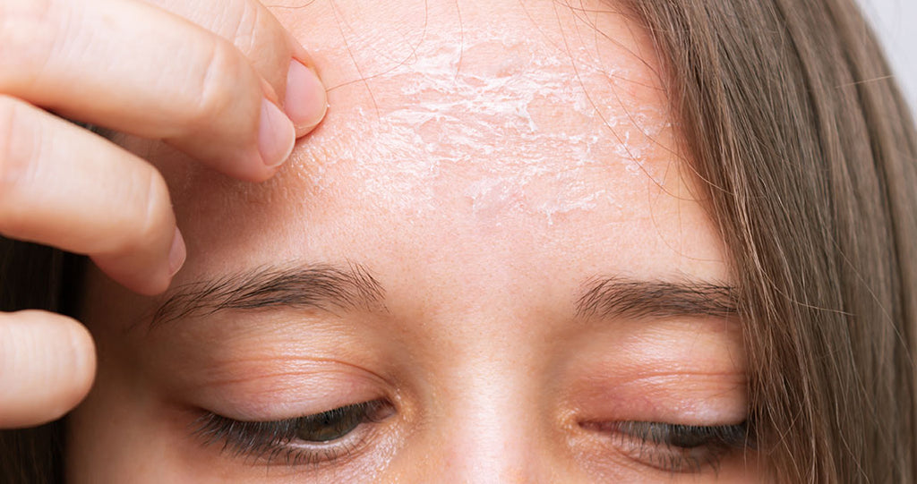 female with dry cracked skin on her forehead