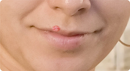 Is that a Cold Sore?