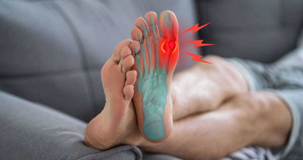 Gout: Symptoms, Causes, and Relief